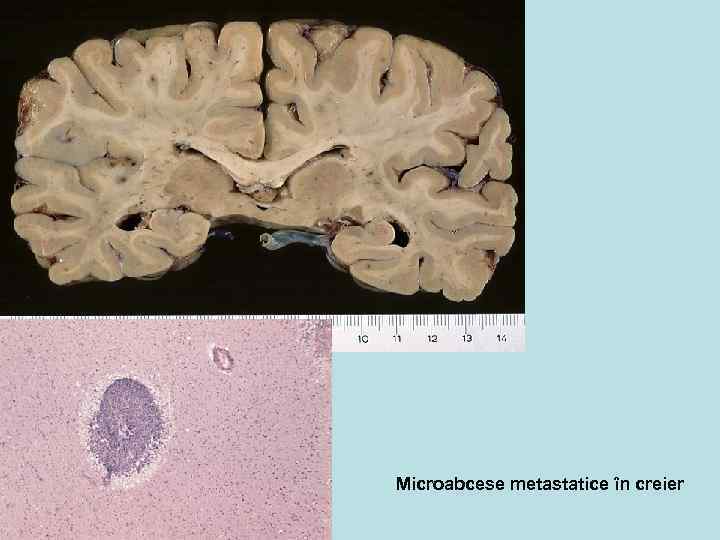 Microabcese metastatice în creier 