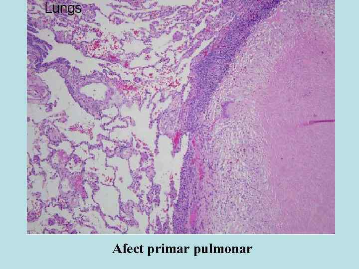 Afect primar pulmonar 