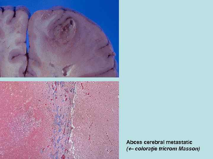 Abces cerebral metastatic ( coloraţie tricrom Masson) 