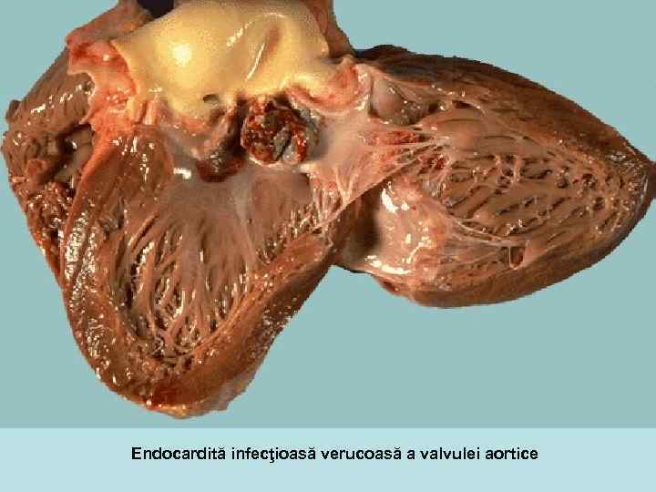 Endocardită infecţioasă verucoasă a valvulei aortice 