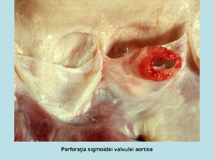 Perforaţia sigmoidei valvulei aortice 