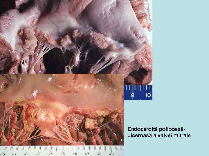 Endocardită polipoasăulceroasă a valvei mitrale 