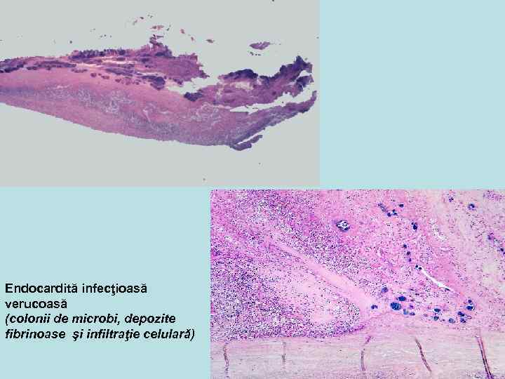 Endocardită infecţioasă verucoasă (colonii de microbi, depozite fibrinoase şi infiltraţie celulară) 