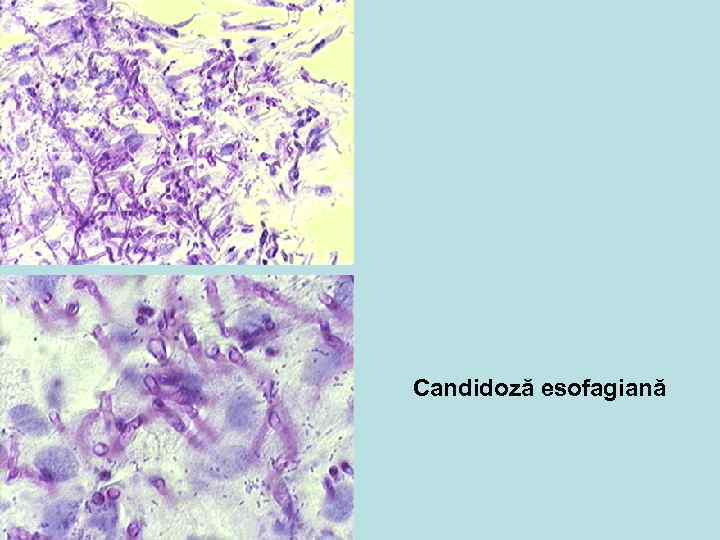 Candidoză esofagiană 