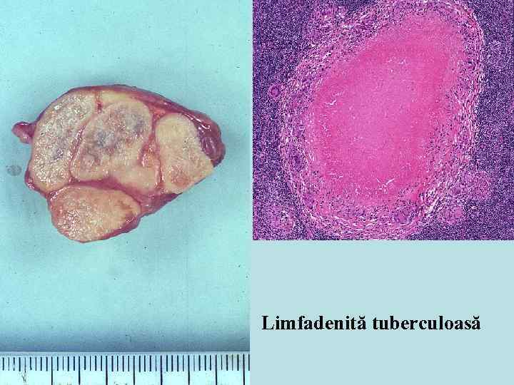 Limfadenită tuberculoasă 