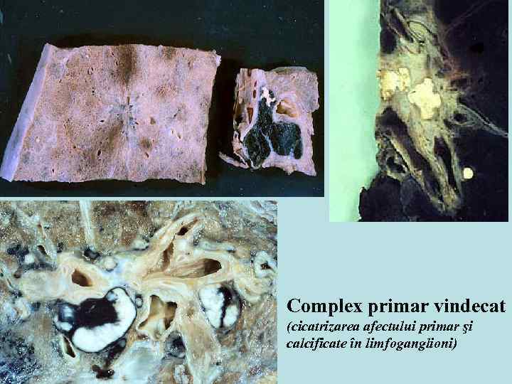 Complex primar vindecat (cicatrizarea afectului primar şi calcificate în limfoganglioni) 