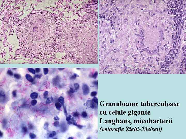 Granuloame tuberculoase cu celule gigante Langhans, micobacterii (coloraţie Ziehl-Nielsen) 