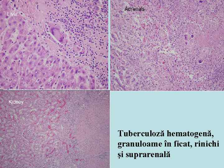 Tuberculoză hematogenă, granuloame în ficat, rinichi şi suprarenală 