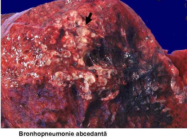 Bronhopneumonie abcedantă 