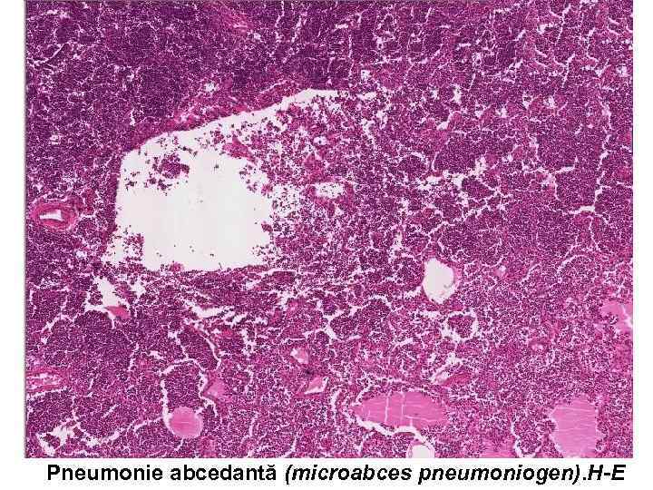 Pneumonie abcedantă (microabces pneumoniogen). H-E 