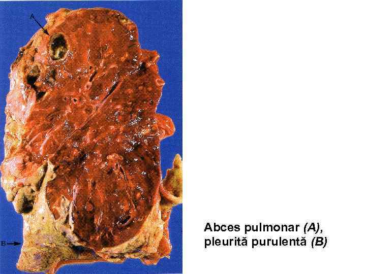 Abces pulmonar (A), pleurită purulentă (B) 