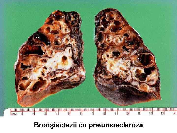 Bronşiectazii cu pneumoscleroză 