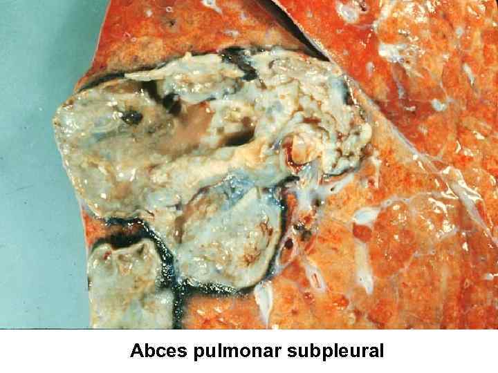 Abces pulmonar subpleural 