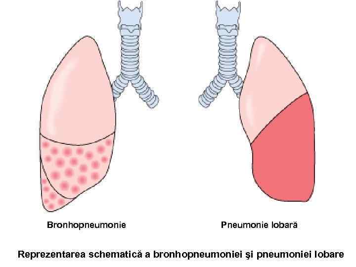 Bronhopneumonie Pneumonie lobară Reprezentarea schematică a bronhopneumoniei şi pneumoniei lobare 