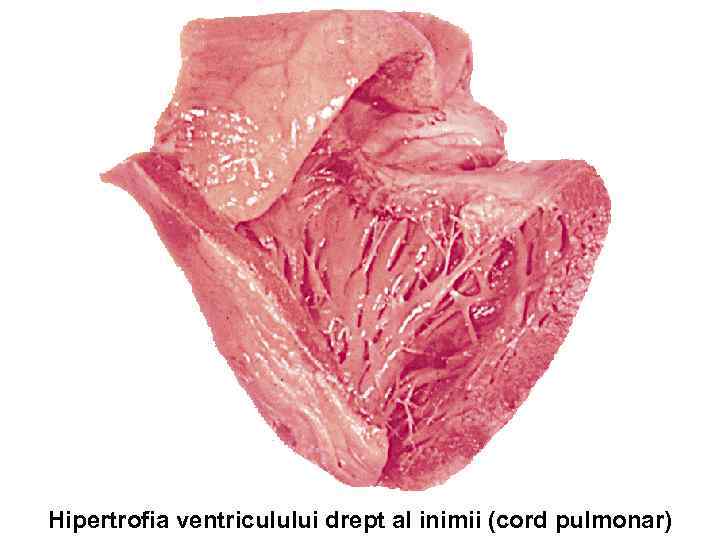 Hipertrofia ventriculului drept al inimii (cord pulmonar) 