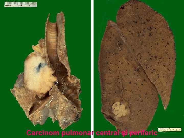Carcinom pulmonar central şi periferic 