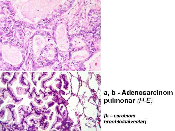 a a, b - Adenocarcinom pulmonar (H-E) [b – carcinom b bronhioloalveolar] 