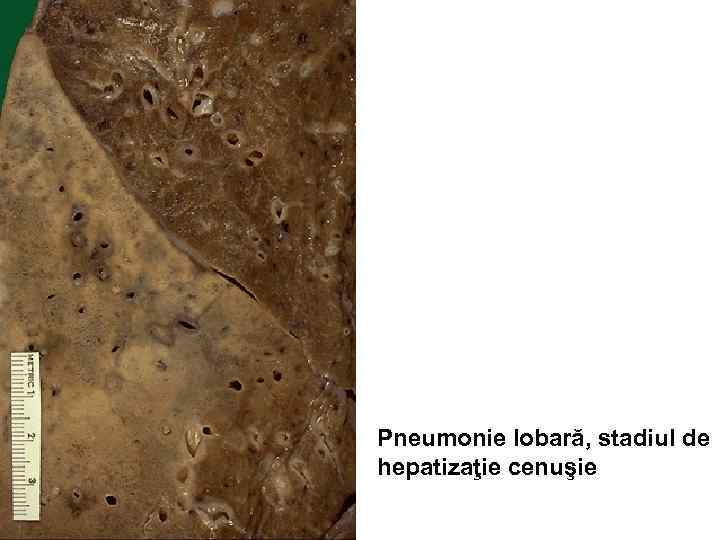 Pneumonie lobară, stadiul de hepatizaţie cenuşie 