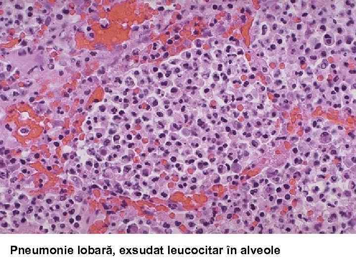 Pneumonie lobară, exsudat leucocitar în alveole 