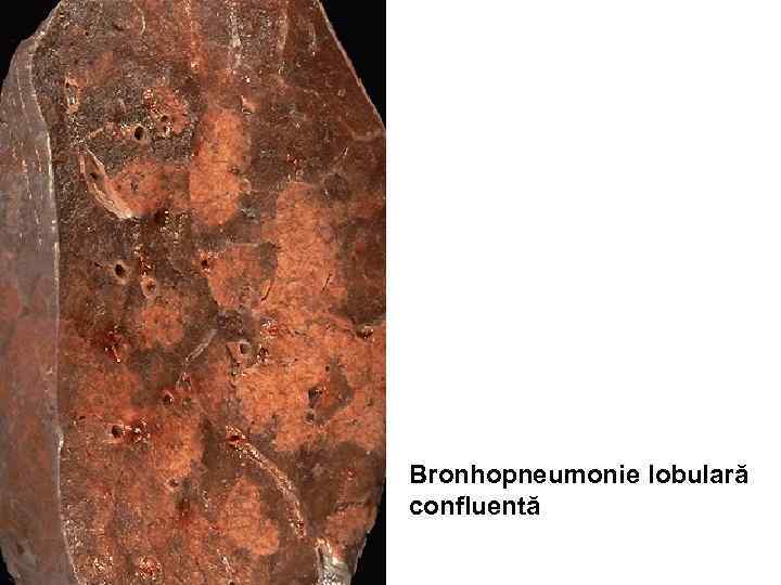 Bronhopneumonie lobulară confluentă 