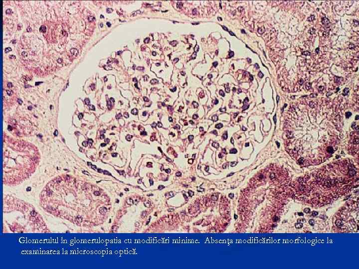 Glomerulul în glomerulopatia cu modificări minime. Absenţa modificărilor morfologice la examinarea la microscopia optică.