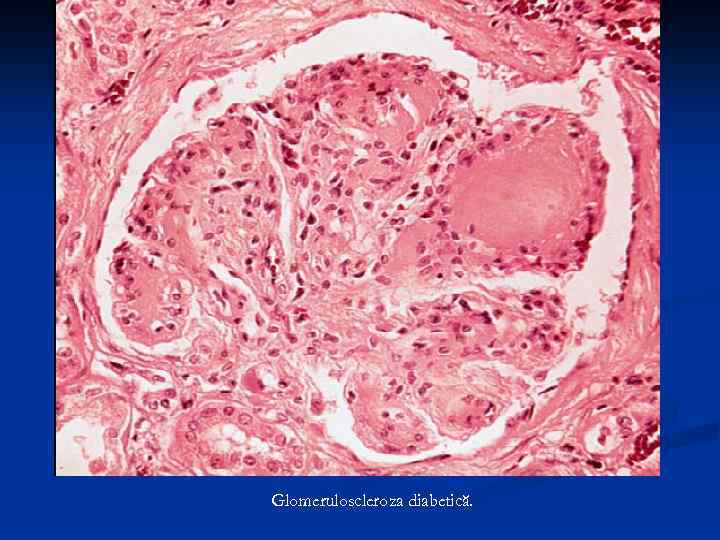 Glomeruloscleroza diabetică. 