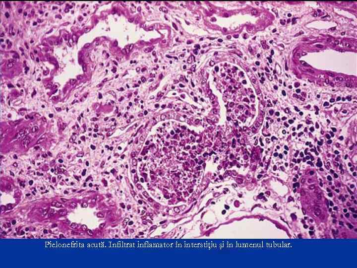 Pielonefrita acută. Infiltrat inflamator în interstiţiu şi în lumenul tubular. 
