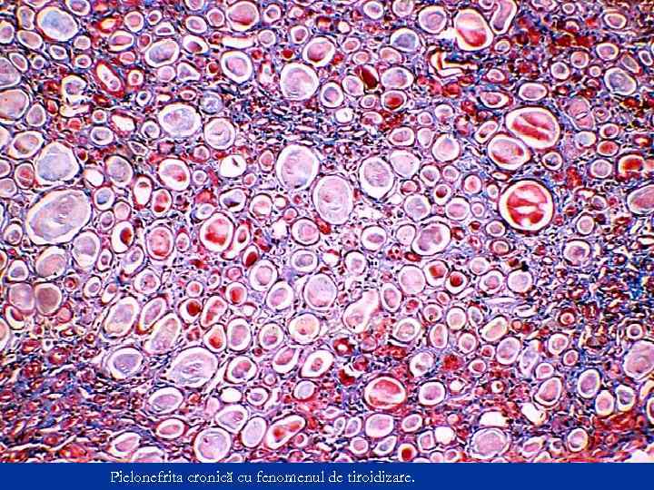 Pielonefrita cronică cu fenomenul de tiroidizare. 