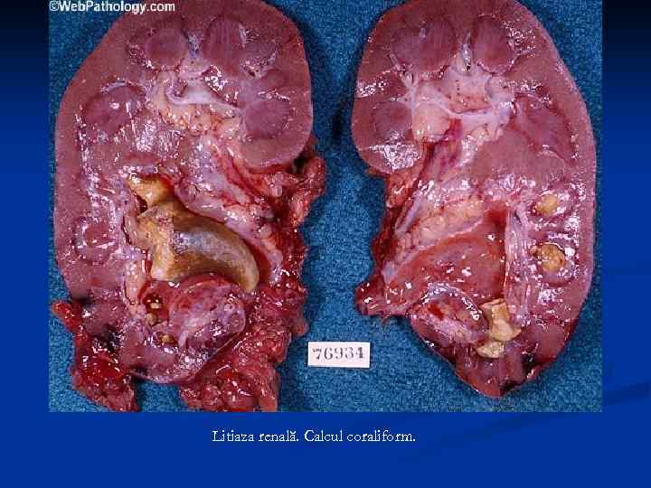 Litiaza renală. Calcul coraliform. 