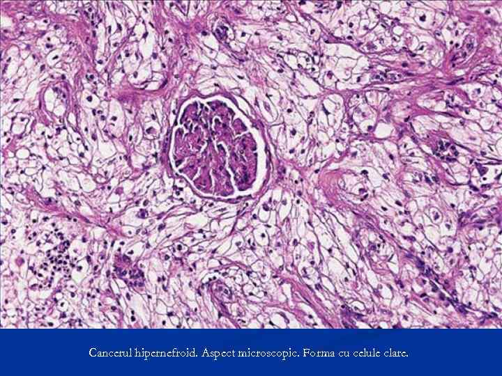 Cancerul hipernefroid. Aspect microscopic. Forma cu celule clare. 