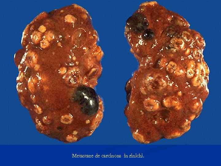 Metastaze de carcinom în rinichi. 