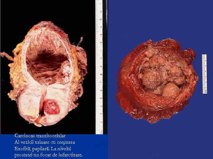 Carcinom tranzitocelular Al vezicii urinare cu creşterea Exofită, papilară. La nivelul prostatei un focar