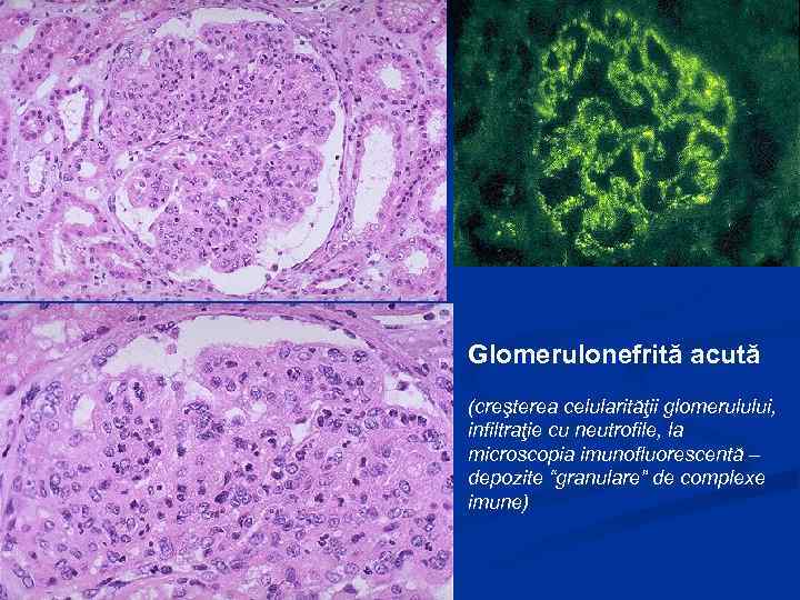 Glomerulonefrită acută (creşterea celularităţii glomerulului, infiltraţie cu neutrofile, la microscopia imunofluorescentă – depozite “granulare”