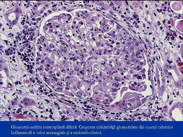 Glomerulonefrita intracapilară difuză. Creşterea celularităţii glomerulare din contul celulelor Inflamatorii a celor mezangiale şi