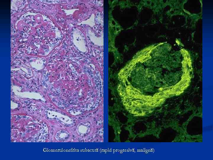 Glomerulonefrita subacută (rapid progresivă, malignă) 