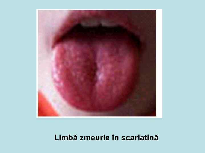 Limbă zmeurie în scarlatină 