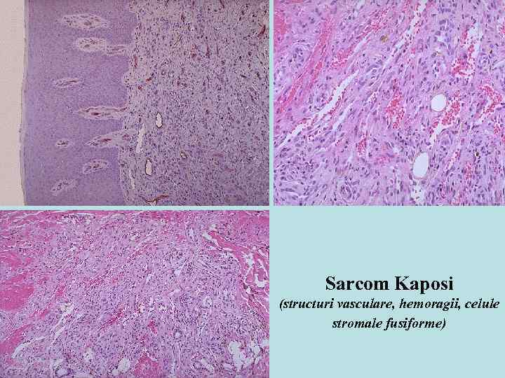 Sarcom Kaposi (structuri vasculare, hemoragii, celule stromale fusiforme) 