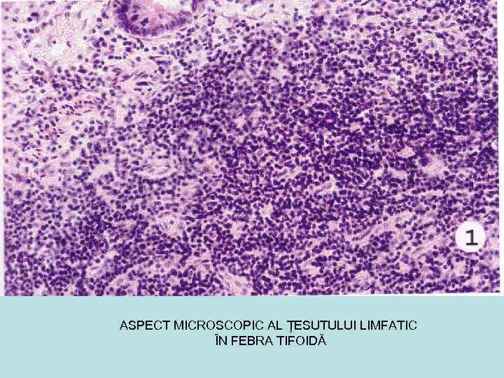 ASPECT MICROSCOPIC AL ŢESUTULUI LIMFATIC ÎN FEBRA TIFOIDĂ 