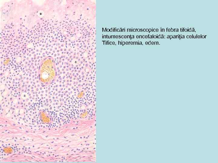 Modificări microscopice în febra tifoidă, intumescenţa encefaloidă: apariţia celulelor Tifice, hiperemia, edem. 