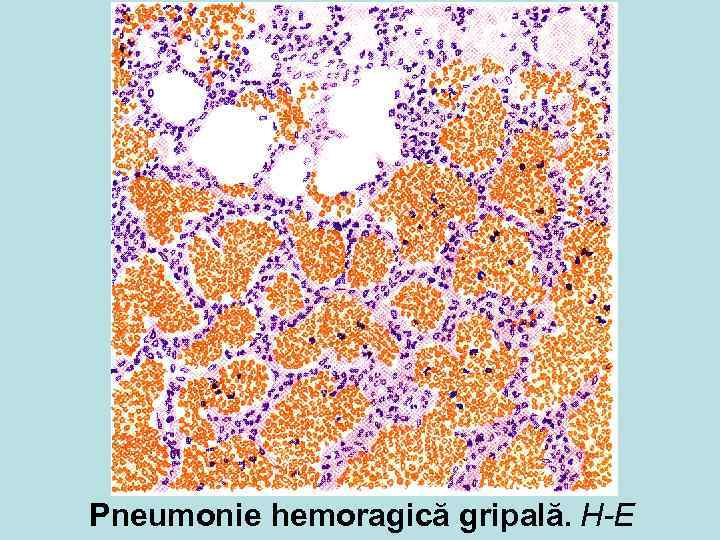 Pneumonie hemoragică gripală. H-E 
