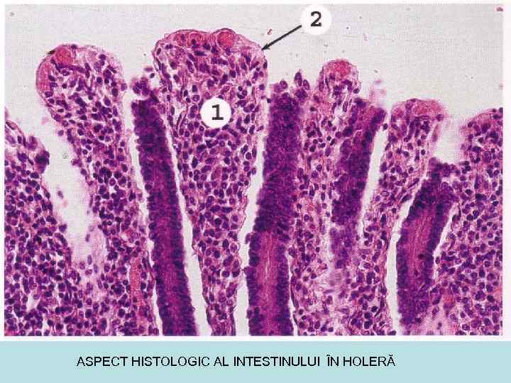 ASPECT HISTOLOGIC AL INTESTINULUI ÎN HOLERĂ 