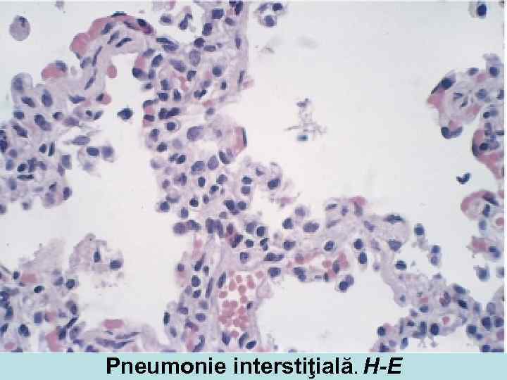 Pneumonie interstiţială. H-E 