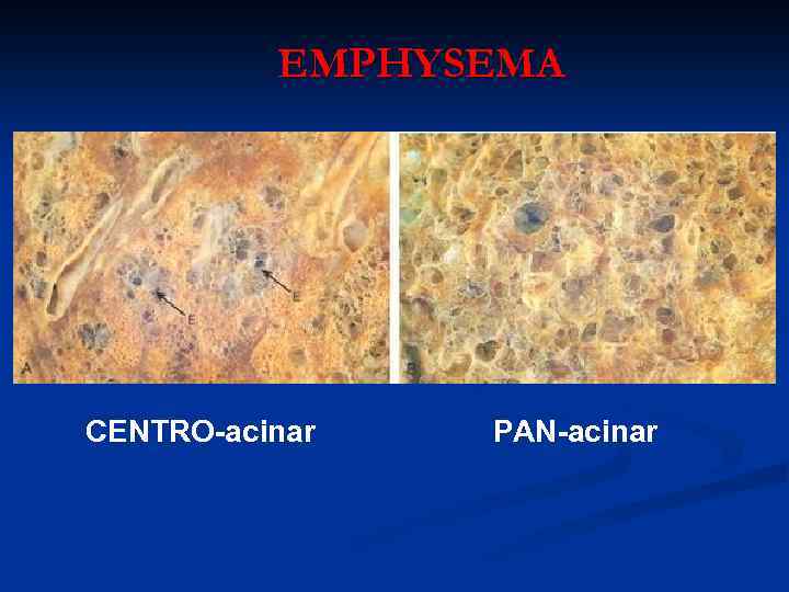 EMPHYSEMA CENTRO-acinar PAN-acinar 