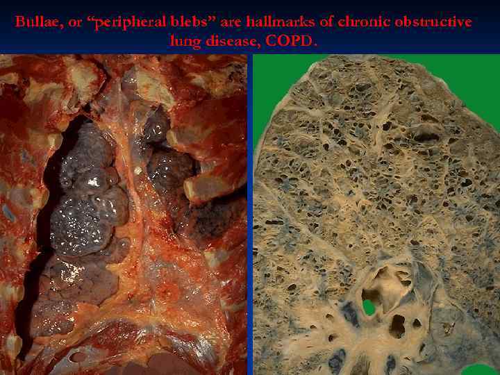 Bullae, or “peripheral blebs” are hallmarks of chronic obstructive lung disease, COPD. 