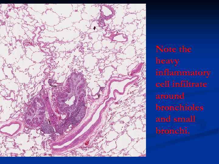 Note the heavy inflammatory cell infiltrate around bronchioles and small bronchi. 