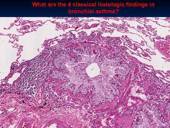 What are the 4 classical histologic findings in bronchial asthma? 