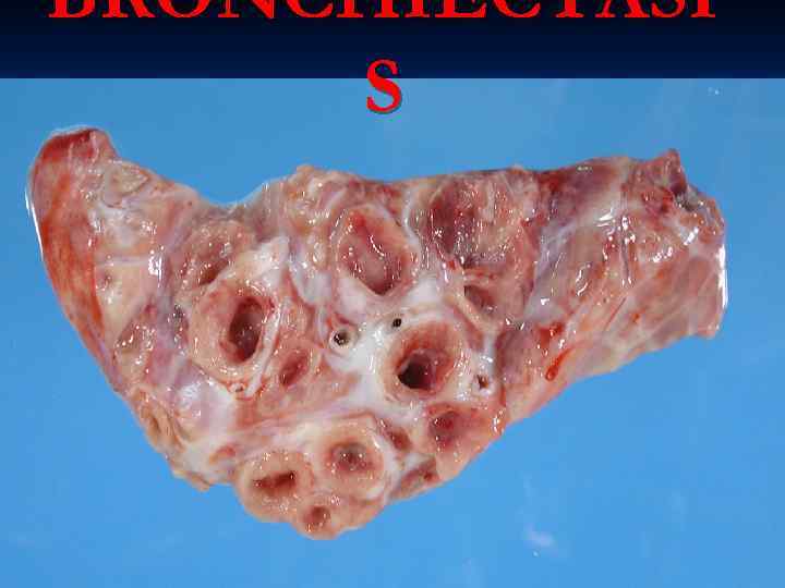 BRONCHIECTASI S 