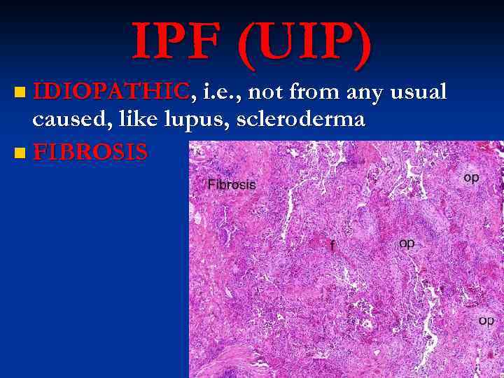 IPF (UIP) n IDIOPATHIC, i. e. , not from any usual caused, like lupus,