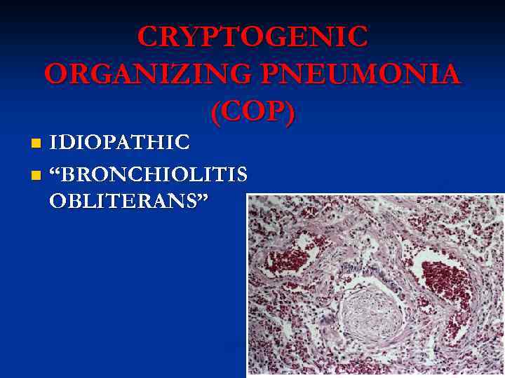 CRYPTOGENIC ORGANIZING PNEUMONIA (COP) IDIOPATHIC n “BRONCHIOLITIS OBLITERANS” n 