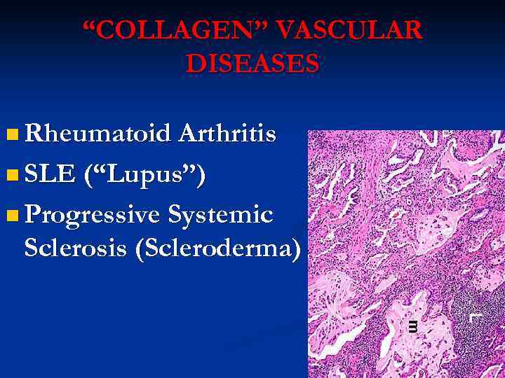 “COLLAGEN” VASCULAR DISEASES n Rheumatoid Arthritis n SLE (“Lupus”) n Progressive Systemic Sclerosis (Scleroderma)